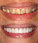 Laser_Gummy Smile_Instant orthodontics