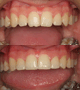 bonding and tooth composite recontouring