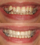 instant orthodontics