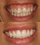 extreme gummy smile makeover with Laser and veneers